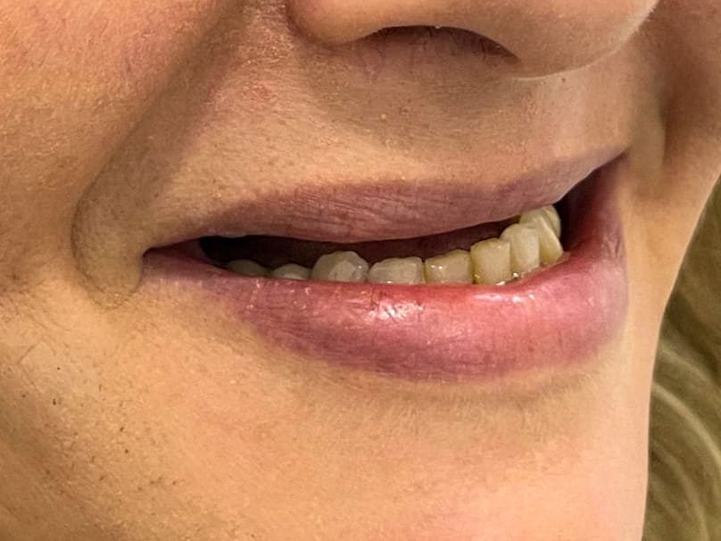 antes e depois_caso clinico_de implante dentário GetSmile Dr Carlos Salvador (1)