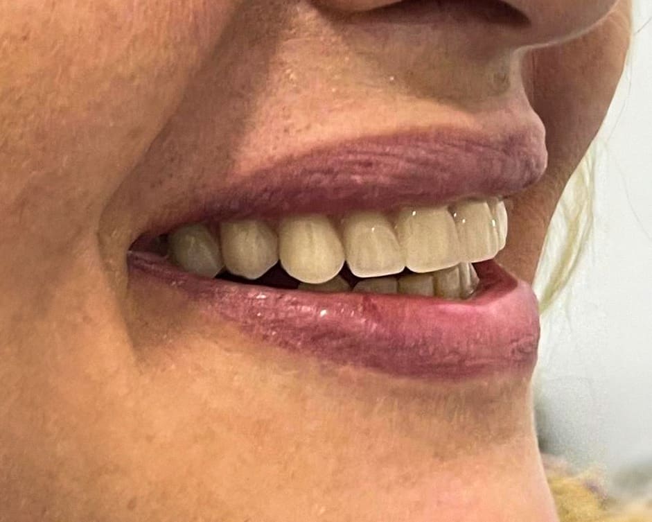 resultado de implante dentário GetSmile Dr Carlos Salvador (1)